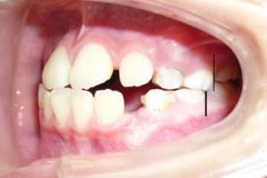 子供の正常な咬み合せはどうやって判断するの フェイストーク麻布十番矯正歯科 矯正歯科専門クリニック