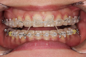 矯正歯科で使われる顎間ゴムとかけ方 フェイストーク麻布十番矯正歯科 矯正歯科専門クリニック