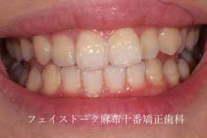 歯の表面の白い斑点 ホワイトスポット の治療 フェイストーク麻布十番矯正歯科 矯正歯科専門クリニック
