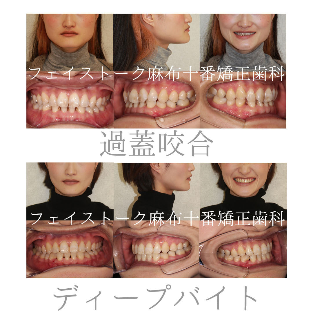 歯 の 矯正 顔 の 変化