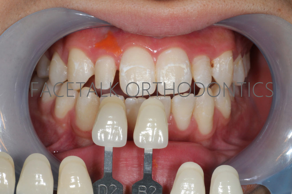 上顎側切歯（2番）矮小歯